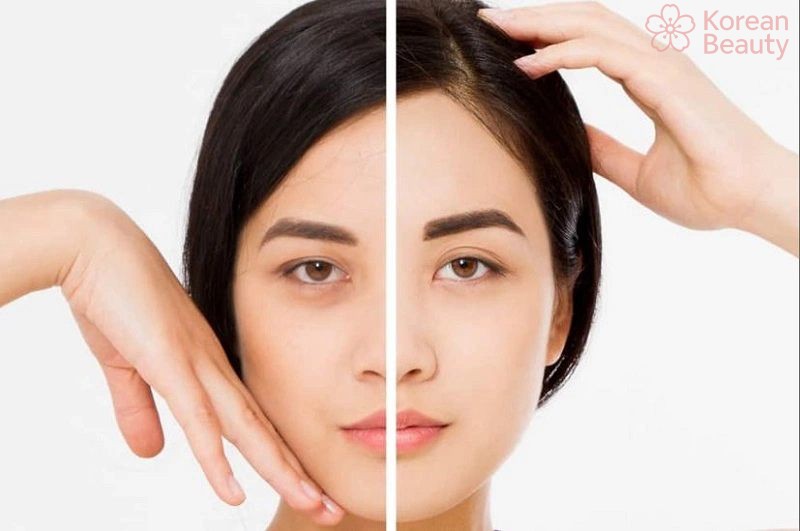 Tại sao liệu pháp nâng cung mày được nhiều người lựa chọn?