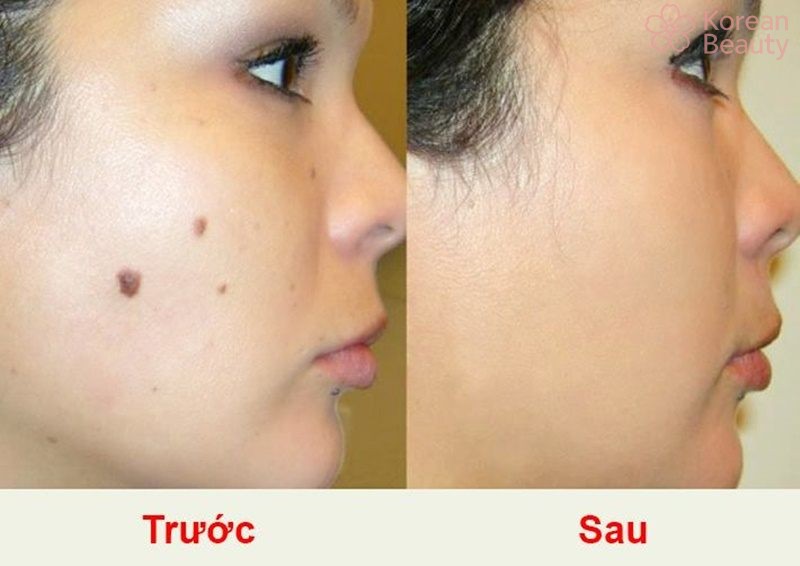 Tại sao nên thực hiện tẩy nốt ruồi?