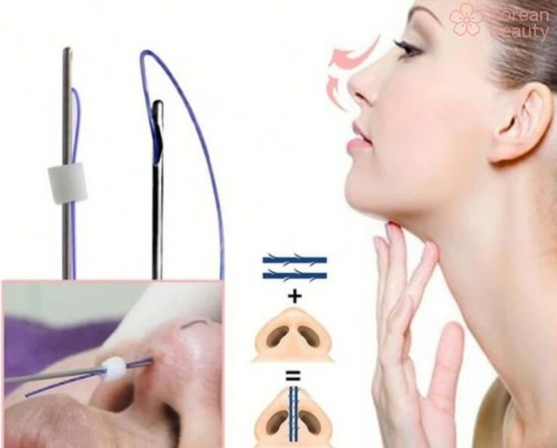 Thông tin tổng quan về cách nâng mũi bằng chỉ