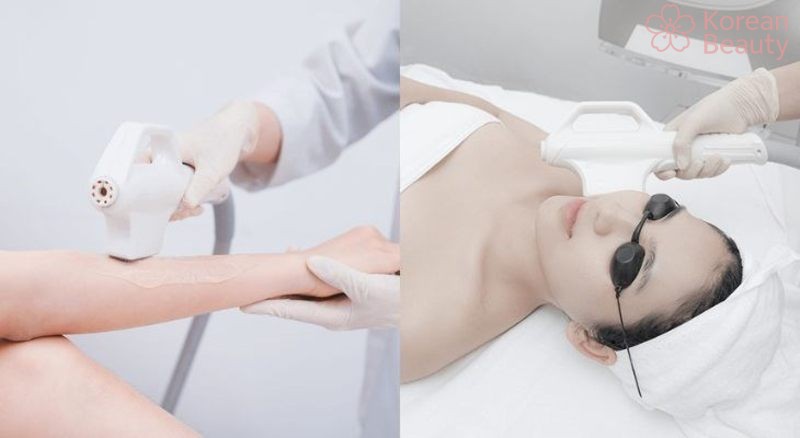 Thông tin tổng quan về Công nghệ triệt lông IPL