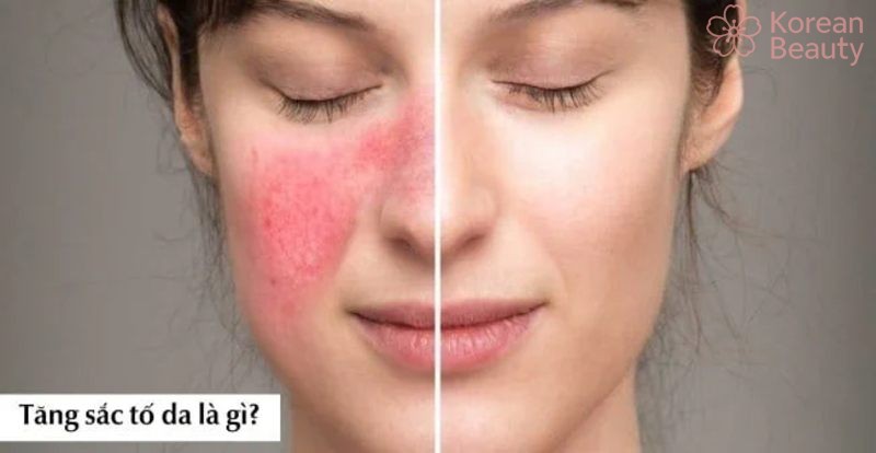 Thông tin tổng quan về da bị tăng sắc tố