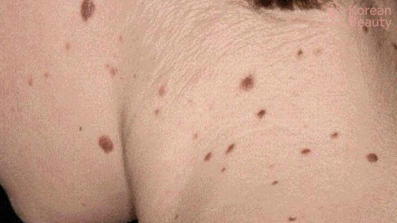 Thông tin tổng quan về tính trạng da xuất hiện vết thâm nâu