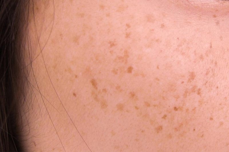 Thông tin tổng quan về tình trạng da nổi đốm nâu không ngứa là gì?