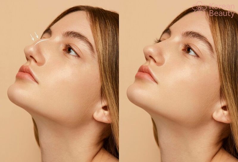 Những vấn đề hay gặp về nâng mũi bao nhiêu tiền