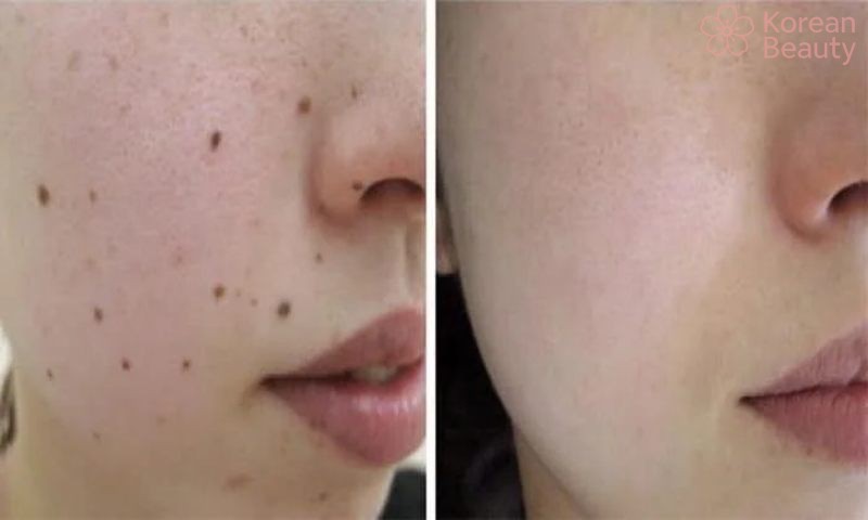 Những phương pháp thực hiện tẩy nốt ruồi Hà Nội phổ biến nhất