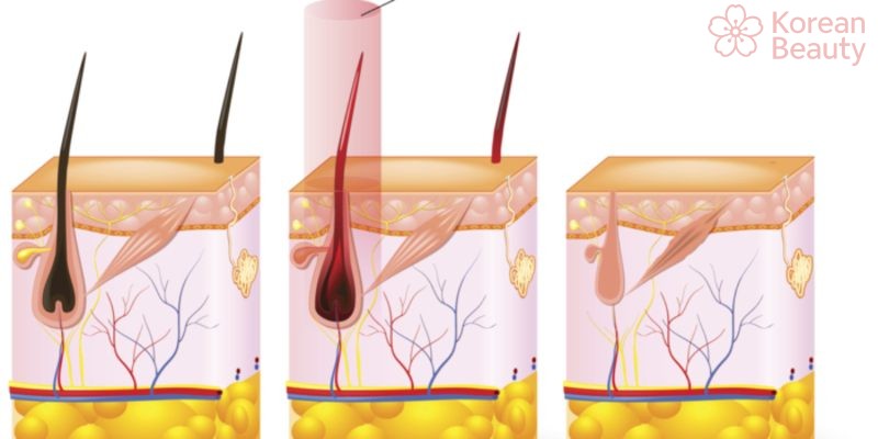 Nguyên lý hoạt động của công nghệ triệt lông công nghệ nano light