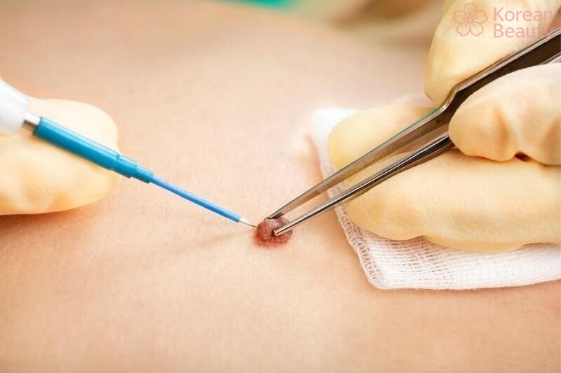 Những phương pháp thực hiện tẩy nốt ruồi phổ biến và hiệu quả nhất