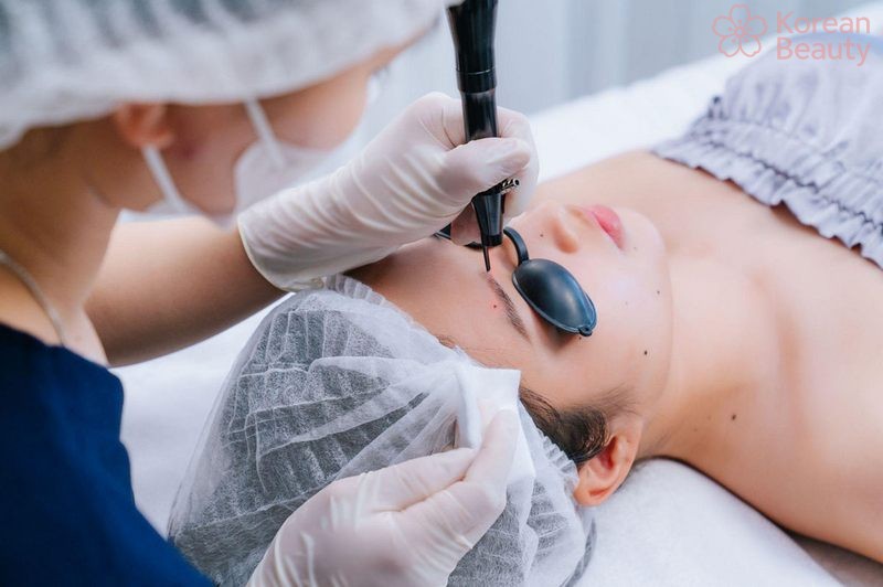 Những yếu tố quan trọng ảnh hưởng đến chi phí xóa nốt ruồi bằng laser