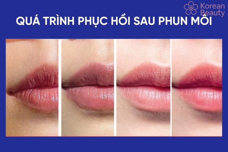 Vai trò quan trọng của việc hồi phục sau khi phun môi