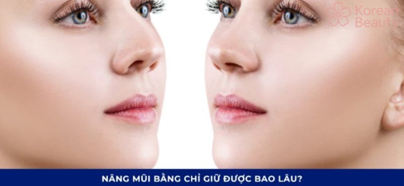 Nâng mũi bằng chỉ giữ được bao lâu và duy trì như thế nào?