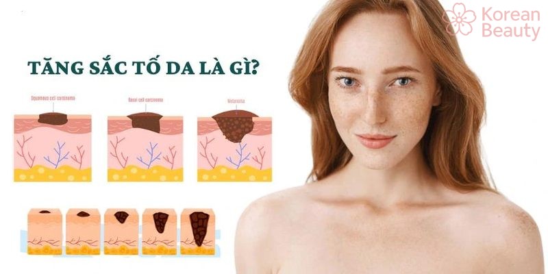 Nguyên nhân gây nên tình trạng da bị tăng sắc tố