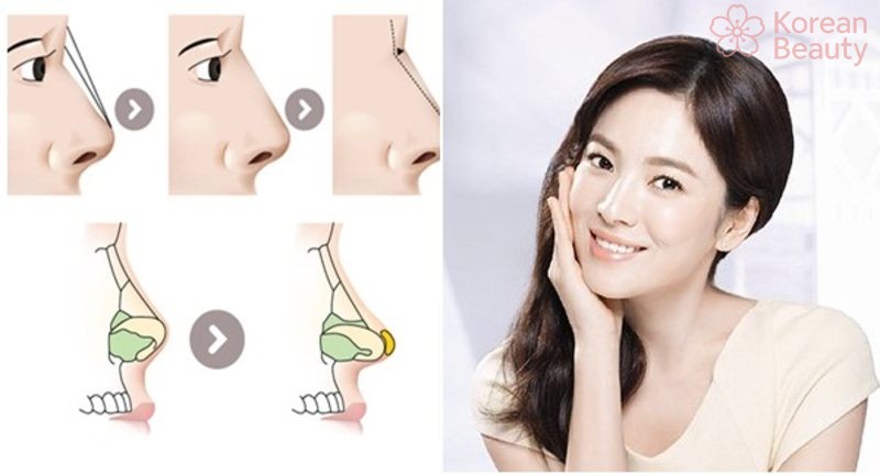 Quy trình thực hiện nâng mũi bán cấu trúc chuẩn xác nhất