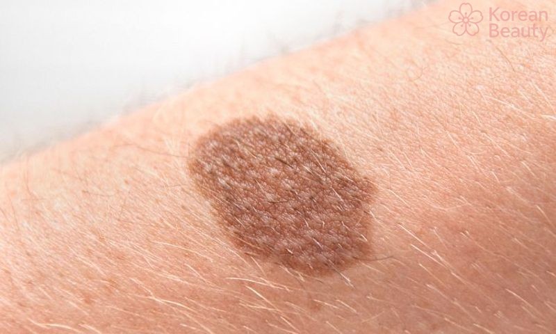 Nguyên nhân gây nên tình trạng da nổi đốm nâu không ngứa