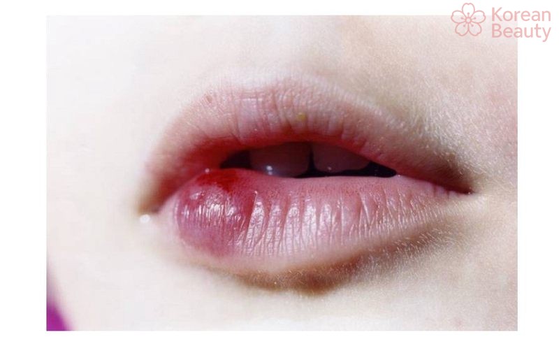 Những nguyên nhân phổ biến gây nên tình trạng phun môi bị hỏng