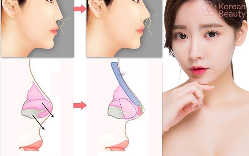 Quy trình thực hiện nâng mũi bằng chỉ chuẩn xác nhất