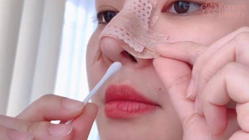 Dấu hiệu nhận biết khi hiệu quả nâng mũi bằng chỉ bắt đầu giảm như thế nào?