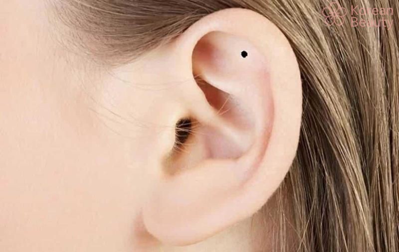 Nguyên nhân dẫn đến hình thành nốt ruồi tai