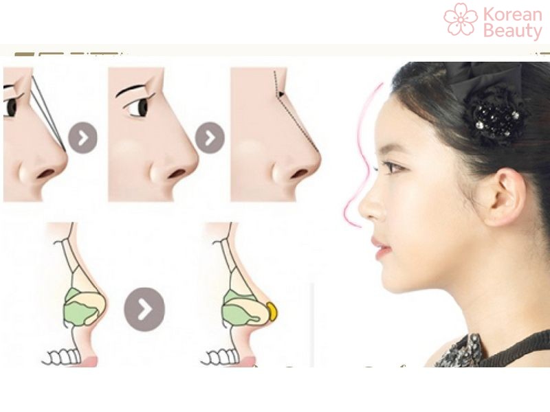 Ưu điểm và nhược điểm của phương pháp nâng mũi bán cấu trúc