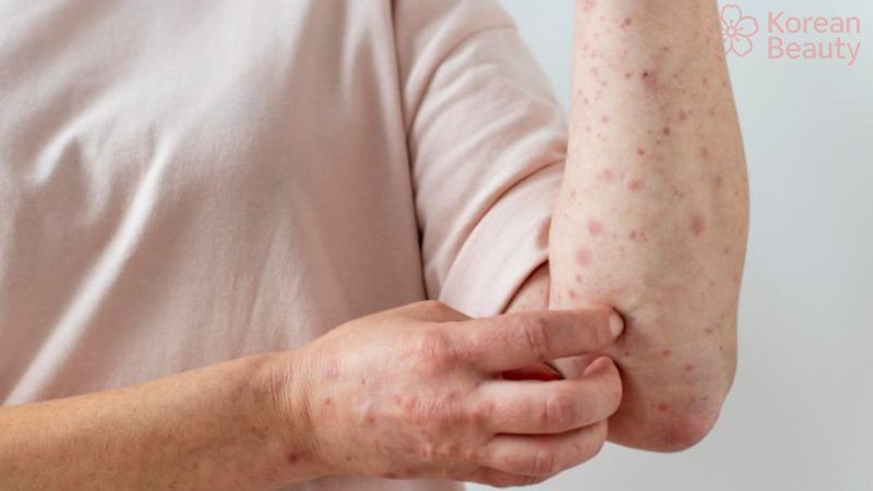 Những phương pháp điều trị da xuất hiện vết thâm nâu hiệu quả