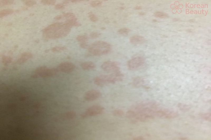 Những dấu hiệu chẩn đoán bệnh da nổi đốm nâu không ngứa