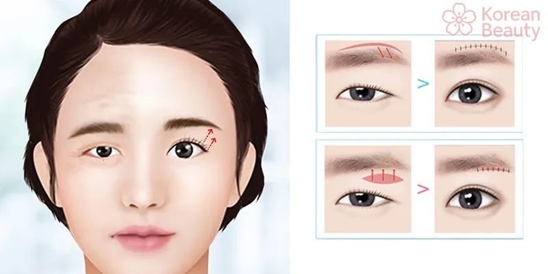 Quy trình thực hiện phương pháp nâng cung mày hiệu quả nhất