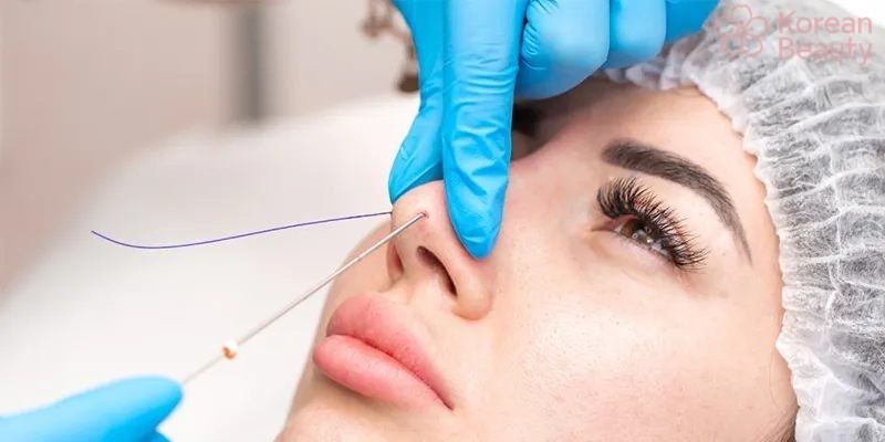 Những phương pháp giúp kéo dài thời gian nâng mũi bằng chỉ