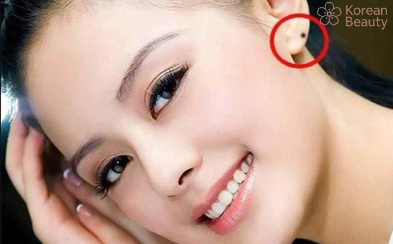 Ý nghĩa về mặt tướng số của nốt ruồi tai