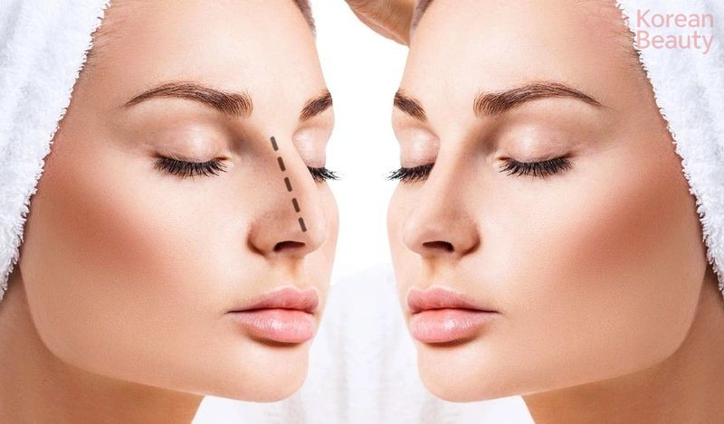 Những yếu tố ảnh hưởng đến chi phí nâng mũi bán cấu trúc