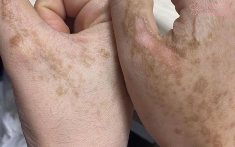 Những biện pháp phòng ngừa da xuất hiện vết thâm nâu 