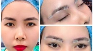 Những rủi ro có thể xảy ra và các tác dụng phụ khi thực hiện nâng cung mày