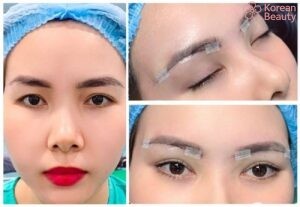 Những rủi ro có thể xảy ra và các tác dụng phụ khi thực hiện nâng cung mày