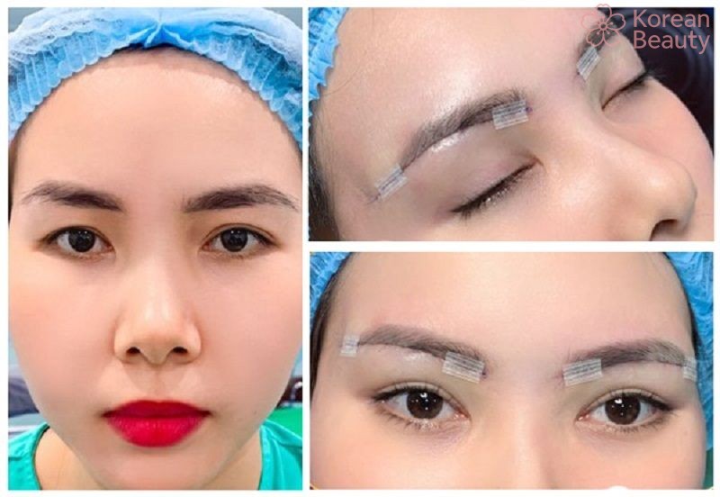 Những rủi ro có thể xảy ra và các tác dụng phụ khi thực hiện nâng cung mày