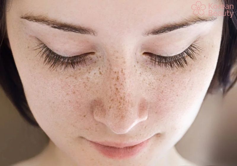 Những phương pháp thực hiện phòng ngừa tình trạng da bị nám nhẹ