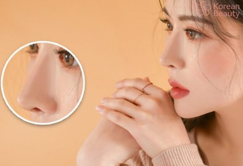 Những biến chứng xấu gây ảnh hưởng đến thời gian duy trì nâng mũi bằng chỉ