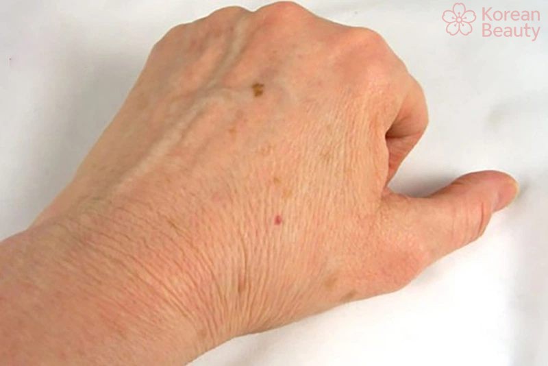 Cách thực hiện trị da xuất hiện vết thâm nâu theo từng vùng da