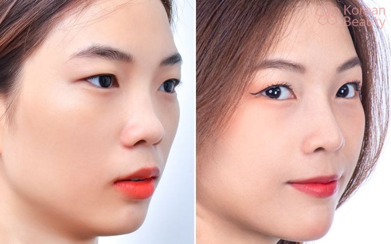 Những chi phí có thể phát sinh khi thực hiện nâng mũi