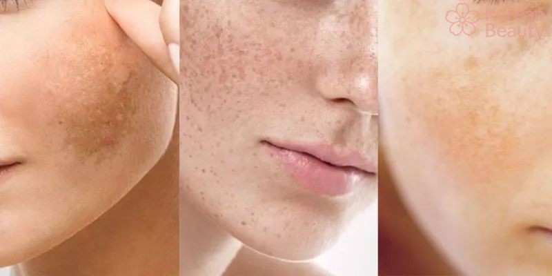 Những hiểu lầm phổ biến trong việc điều trị da bị nám nhẹ