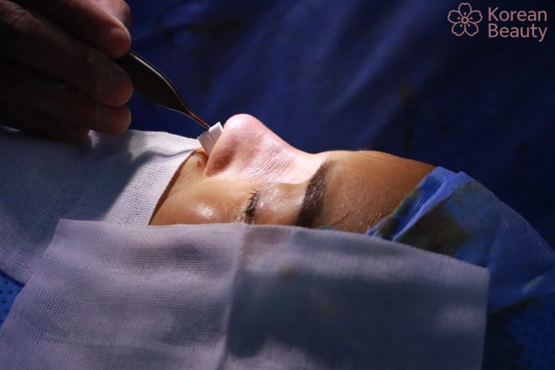 Những biến chứng có thể gặp và cách phòng tránh các biến chứng khi nâng mũi bán cấu trúc