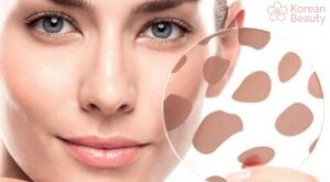 Kết hợp nhiều phương pháp để điều trị da xuất hiện vết thâm nâu hiệu quả