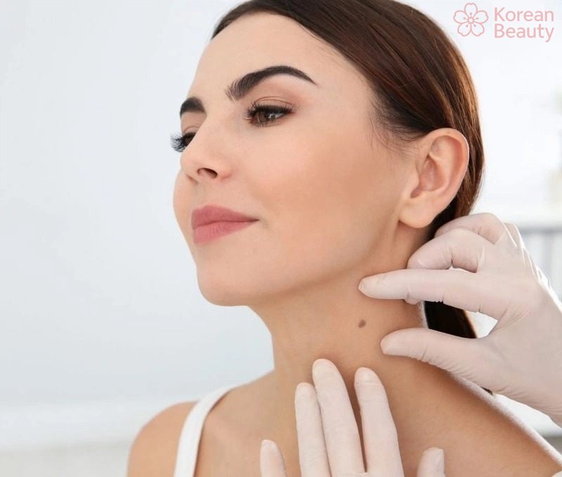 Những phương pháp phòng ngừa và chăm sóc da sau kihi thực hiện tẩy nốt ruồi