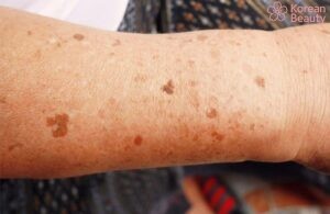 Những tình trạng đặc biệt liên quan đến bệnh da nổi đốm nâu không ngứa