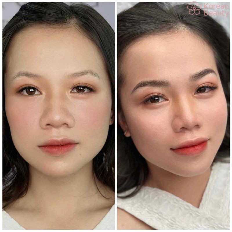 Những vấn đề liên quan đến phương pháp nâng cung mày