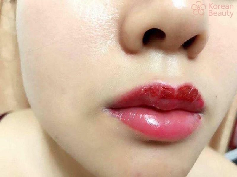 Những phương pháp điều trị phun môi bị hỏng dân gian có hiệu quả không?