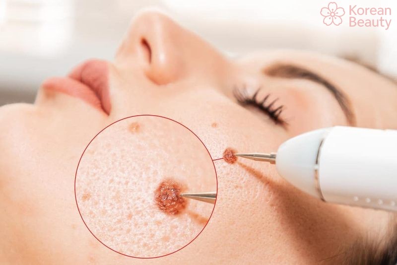 Những thắc mắc thường gặp khi thực hiện tẩy nốt ruồi