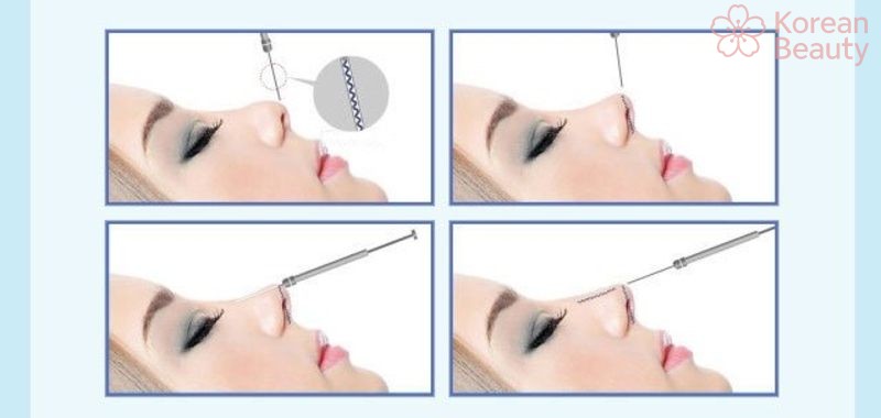 Những biến chứng có thể gặp phải sau khi nâng mũi bằng chỉ