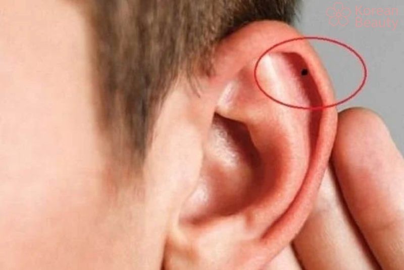 Những hiểu lầm thường hay gặp về nốt ruồi tai