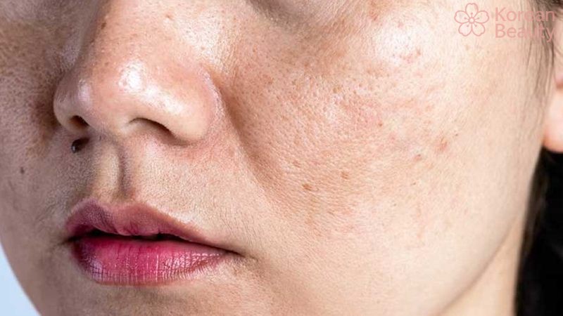 Những vấn đề liên quan đến da xuất hiện vết thâm nâu