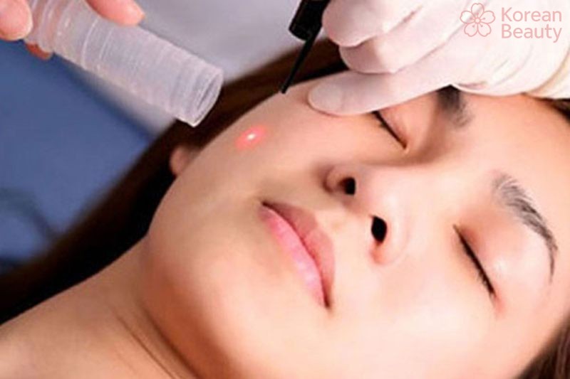 Những vấn đề hay gặp về cách tẩy nốt ruồi tại Hải Phòng