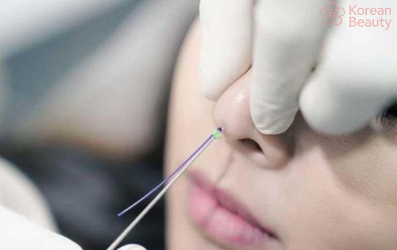 Kinh nghiệm lựa chọn địa chỉ nâng mũi bằng chỉ hiệu quả