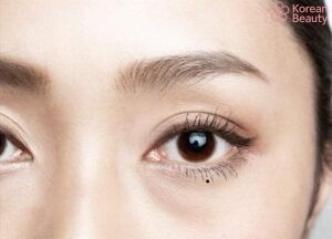 Những vấn đề liên quan đến nốt ruồi dưới bọng mắt trái nữ